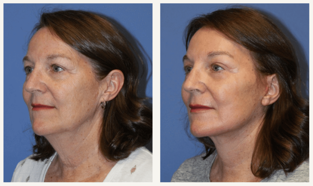 deep-plane-facelift-6-things-that-determine-whether-your-results-will-last