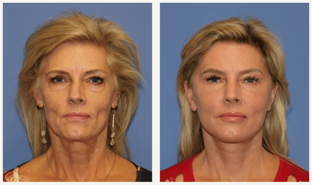 deep-plane-facelift-cost-guide-budgeting-for-advanced-facial-rejuvenation