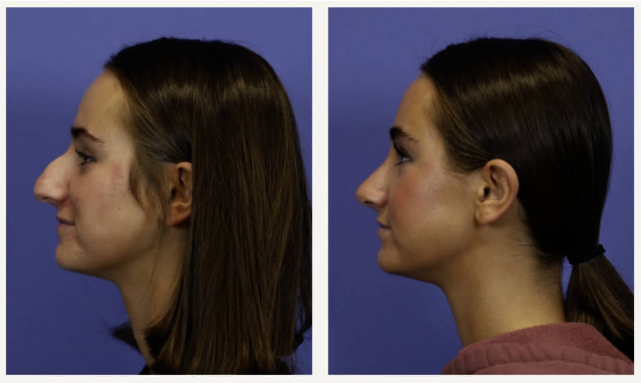 how-much-are-nose-jobs-in-utah-a-realistic-look-at-budgeting-for-rhinoplasty