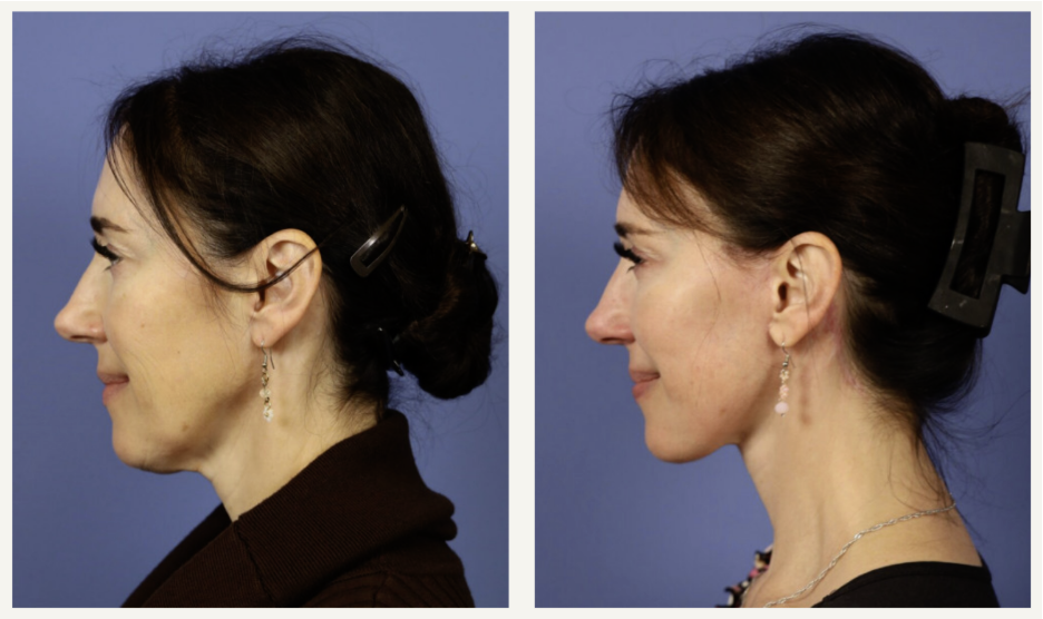 mini-facelifts-near-me-how-to-find-trusted-providers-in-your-area